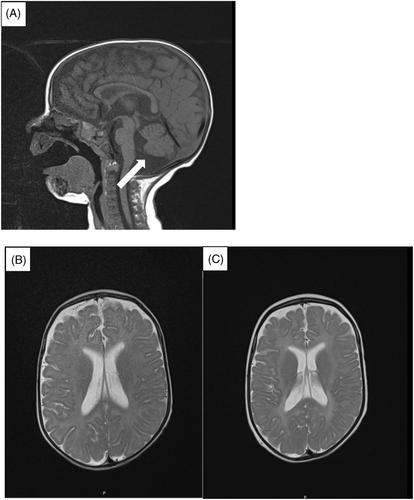 Huppke–Brendel syndrome: Novel cases and a therapeutic trial with ketogenic diet and N-acetylcysteine