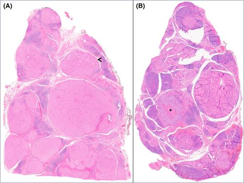 Can thyroid histomorphology identify patients with PTEN hamartoma tumour syndrome?