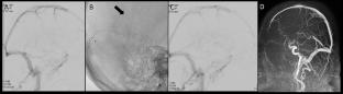 Endovascular treatment of deep sinus vein thrombosis 72 h after initial cardioembolic stroke