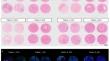 Heterogeneity of hepatocellular carcinoma that responds differently to combination therapy with TACE and Sorafenib as determined by digital spatial gene expression profiling.