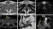 IgG4-related disease with subcutaneous involvement and the associated diagnostic challenges with MRI.
