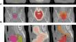 Dosiomics-based detection of dose distribution variations in helical tomotherapy for prostate cancer patients: influence of treatment plan parameters.