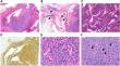 Musculoskeletal glomus tumor: a review of 218 lesions in 176 patients.