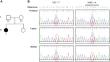 A novel compound heterozygous mutation of UFC1 in a patient with neurodevelopmental disorder.