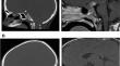 A tale of two pediatric craniopharyngiomas exemplifying treatment strategies.