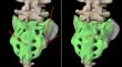 Implantation of S1AIS has priority as a sacroiliac joint fixation technique.