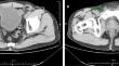 Preoperative CT findings predict the development of metachronous contralateral inguinal hernia after unilateral inguinal hernia repair: a single-center retrospective cohort study.