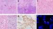 Clinical and pathological analyses of 14 cases of angiomatoid fibrous histiocytoma.