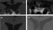 Semaglutide as a promising treatment for hypothalamic obesity: a six-month case series on four females with craniopharyngioma.