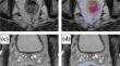 The potential of an artificial intelligence for diagnosing MRI images in rectal cancer: multicenter collaborative trial.