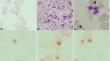 Sideroblastic anemia Secondary to anti-tubercular Therapy in a Patient with Acute Promyelocytic Leukemia