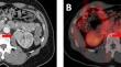 Imaging of Chromophobe Renal Cell Carcinoma with <sup>99m</sup>Tc-Sestamibi SPECT/CT: Considerations Regarding Risk Stratification and Histologic Reclassification.