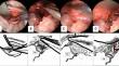 An innovative reconstruction procedure for fractures extending to the posterior orbital floor: utilizing the inferior margin of the greater wing of the sphenoid bone for reconstruction.