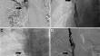 Review of Sharp Recanalization Techniques in Central Venous Occlusions.