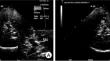 Changes in the correlation between substantia nigra hyperechogenicity area and Parkinson's disease severity at different Hoehn and Yahr stages.