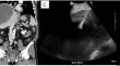 ESR Essentials: image guided drainage of fluid collections-practice recommendations by the Cardiovascular and Interventional Radiological Society of Europe.