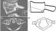 Morphometric analysis of atlas lateral mass in Down syndrome cases with relevance to surgical intervention.