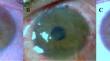 Limbal graft transplantation: a rare implementation in pediatric limbal stem cell deficiency.