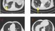 Assessing the diagnostic utility of serum tumor markers for lung cancer detection in patients with interstitial pneumonia.