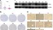 FOXC1 transcriptionally suppresses ABHD5 to inhibit the progression of renal cell carcinoma through AMPK/mTOR pathway.