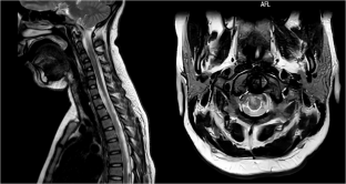 Idiopathic cervical cord infarction in a young girl presenting with acute neck pain and flaccid paralysis: a case report