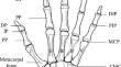 Design and analysis of rehabilitation hand based on segmented multi-chamber actuator