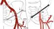 Morphology of the lateral circumflex femoral artery in adult cadavers