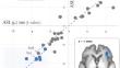 Right anterior insula ASL hypoperfusion as a diagnostic biomarker of prodromal and mild dementia with Lewy bodies: preliminary evidence using a Bayesian approach.