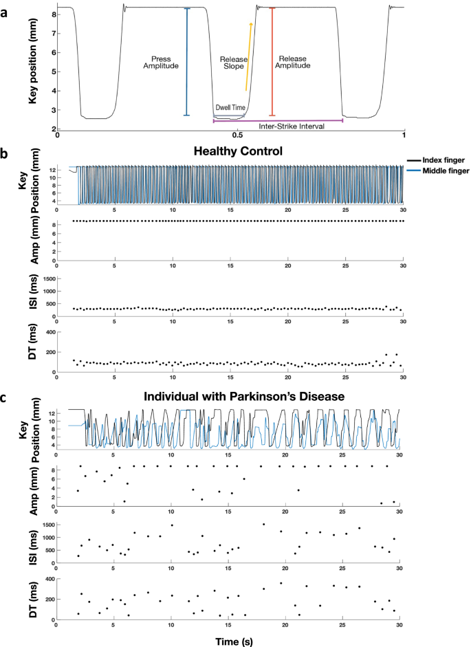 The digital signature of emergent tremor in Parkinson's disease.