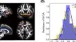 Loss of synaptic density in nucleus basalis of meynert indicates distinct neurodegeneration in Alzheimer's disease: the RJNB-D study.