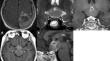 Solitary isolated disseminations of glioblastoma to sellar and suprasellar regions: two case reports.