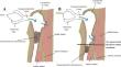 Nasolacrimal duct rhinostomy for low-level nasolacrimal duct obstruction:long-term outcomes and surgical selection paradigm.