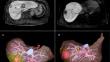 Comparison of laparoscopic liver resection for the ventral versus the dorsal areas of segment 8.