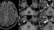 Cochlear hemorrhage in a patient with pneumococcal meningitis.