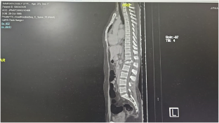 Restoring initial steps by intermittent theta burst stimulation in complete spinal cord injury patient: a case report.