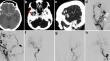 Combined open surgery and endovascular embolization for a ruptured sphenoid wing dural arteriovenous fistula.