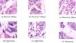 Histopathology image analysis for gastric cancer detection: a hybrid deep learning and catboost approach