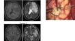 The Pathogenic Role of Anti-Granulocyte-Macrophage Colony-Stimulating Factor Autoantibodies in the Nocardiosis with the Central Nervous System Involvement.