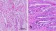 Morphological changes in the biliary mucosa in pediatric patients with congenital biliary dilatation are more influenced by the duration of amylase exposure than by amylase levels in the gallbladder.