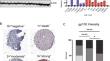 GP100 expression is variable in intensity in melanoma.