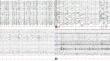 L-serine treatment in a patient with refractory epilepsy due to a GRIN2A missense mutation.