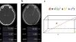 Intraoperative 3D fluoroscopy accurately predicts final electrode position in deep brain stimulation surgery.