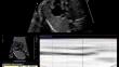 Fetal Right Heart Strain in Systemic Right Ventricles and Impact on Post-surgical Outcomes.