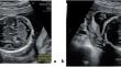 Prenatal Diagnosis of Poretti-Boltshauser Syndrome - a Case Report of a Molar Tooth Sign Mimic.