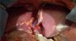 Advocating for a "shift-to-left" in transplant oncology: left grafts, RAPID and dual graft.