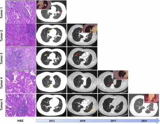 Innate immune dynamics in the context of multisite EGFR mutations in lung adenocarcinoma.