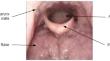 Airway and Airway Obstruction Site Segmentation Study Using U-Net with Drug-Induced Sleep Endoscopy Images.