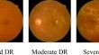 DiabSense: early diagnosis of non-insulin-dependent diabetes mellitus using smartphone-based human activity recognition and diabetic retinopathy analysis with Graph Neural Network