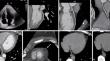 A twisted diagnosis of chest pain: the prominent role of coronary computed tomography.