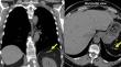 Autosplenectomy in systemic sclerosis.